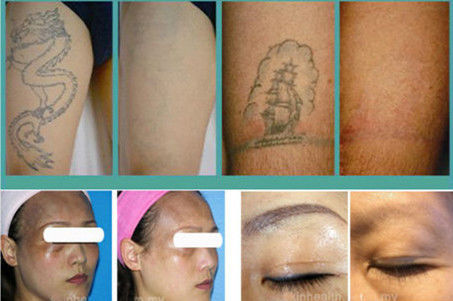 o tamanho de ponto branco e cinzento 2 do laser, 8mm Q comutou o removedor da tatuagem da energia de laser do ND YAG